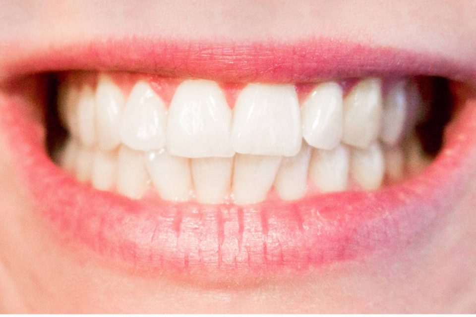 How Teeth Grinding Can Negatively Affect Your Health