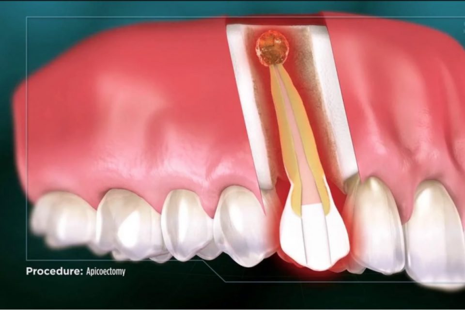 Understanding the Difference of an Apicoectomy vs a Root Canal